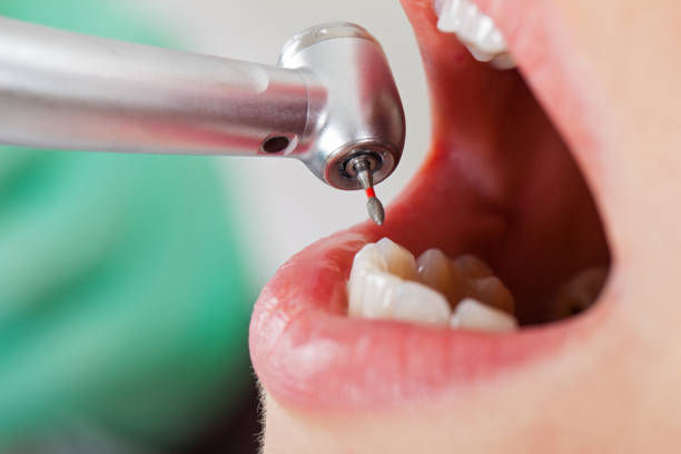 Best Broken or Chipped Tooth Repair in Brookfield, IL
